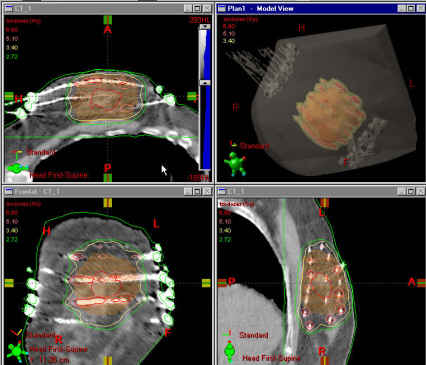 Radiation treatment plan for multi-catheter breast brachytherapy