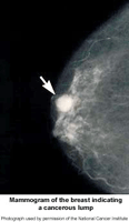 Breast X-ray image
