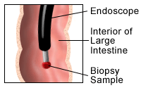 Illustration of endoscope in large intestine