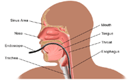 Illustration of upper endoscopy