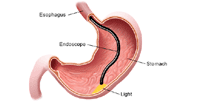 Illustration of endoscope in stomach