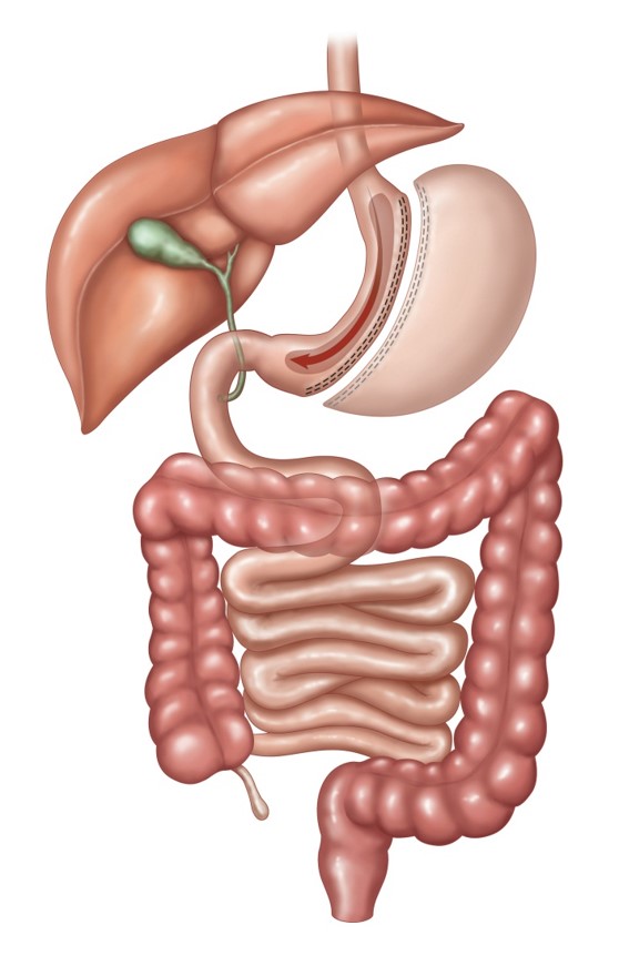 Illustration linking to Sleeve Gastrectomy page
